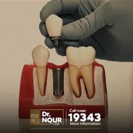Dental implants